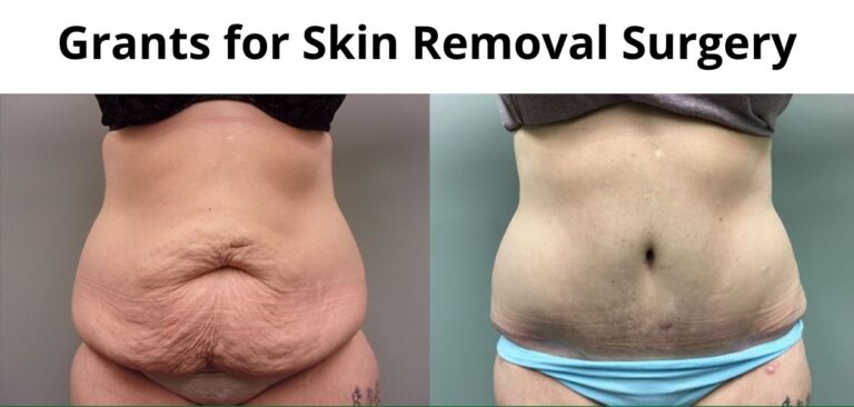 Top 5 Grants for Skin Removal Surgery for Free in 2023