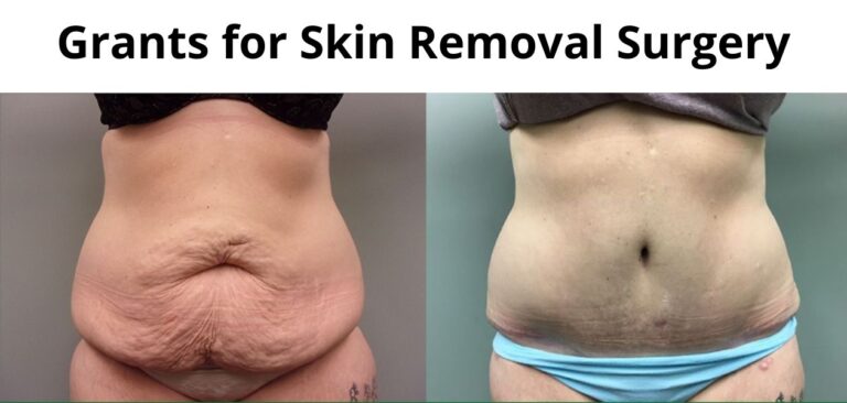 Top 5 Grants for Skin Removal Surgery for Free in 2023