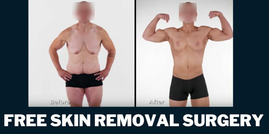 Grants for Skin Removal Surgery free